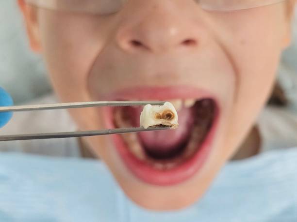 Best Same-Day Emergency Dental Services in Lena, IL